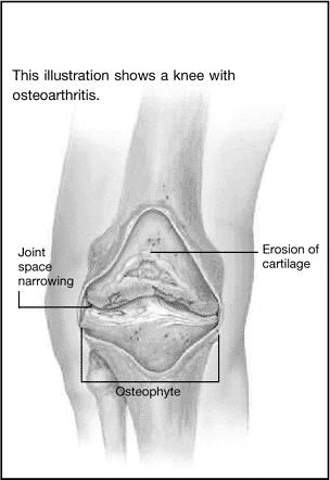 Degenerative Bone Disease Osteoarthritis (OA) Most common of all arthritis Leading cause of pain and disability in elderly Loss of articular cartilage in joints 90% people has x-ray evidence of OA by