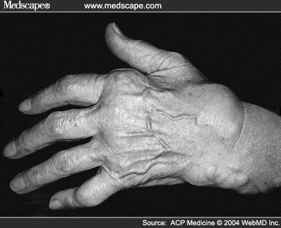 degenerative changes Self care deficit Autoimmune and Inflammatory Disorder Rheumatoid Arthritis Systemic disease Causes inflammation of