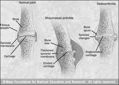 Rheumatoid Arthritis (RA) Patho Auto-antibodies form - attack healthy tissue, Inflammation first in synovial membrane Inflammation spreads: articular cartilage, joint capsule, ligaments and tendons