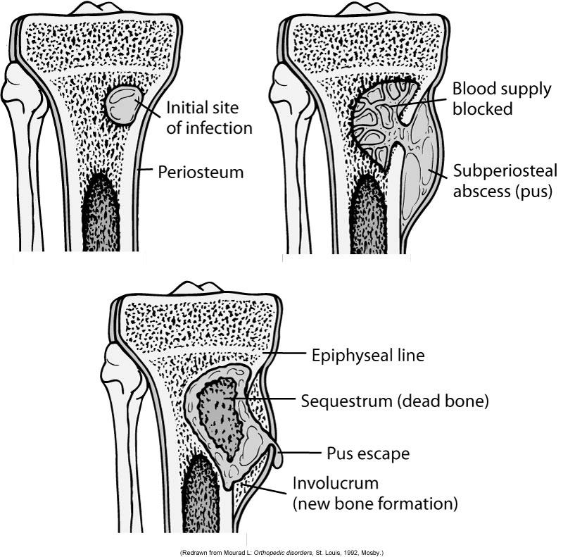 Osteomyelitis - Patho Phagocytosis Pus Periosteum lifts Ischemia and necrosis Etiology Hematogenous Osteomyelitis Sources of pathogens: UTI, soft tissue infections, endocarditis, and infected IV