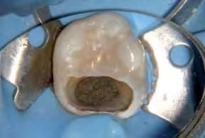 _Surgical applications For many years, the root end was surgically prepared by drilling a Class 1 preparation into the dentine, using
