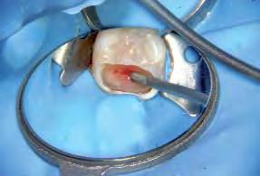 This approach had many disadvantages, mainly the inability to create a preparation in the longitudinal axis of the root canal and to