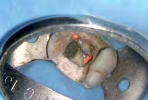 20a h). The risk of air bubbles can therefore be avoided. As a result, the retro-root canal filling will always be well compacted.