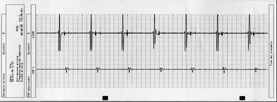 Patient initiated IEGM storage Magnet-triggered IEGM in a patient with palpitations.