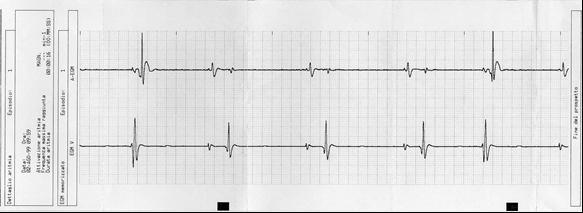 Patient initiated IEGM storage Magnet-triggered EGM in a patient with palpitations.