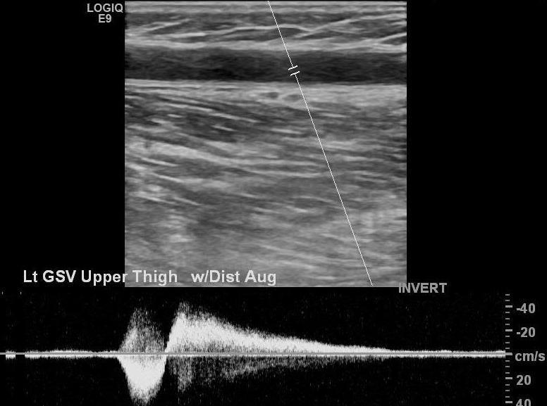 9. Evaluation with Duplex Ultrasound A cutoff values for reflux femoral and popliteal veins: 1 second GVS, SSV, tibial, deep femoral veins: