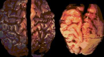Brain damage resulting from prenatal alcohol Brain of baby with exposure to alcohol Brain