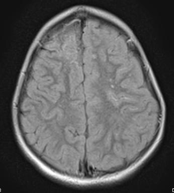 MRI Axial flair MR with ivy sign (red arrow, bright signal