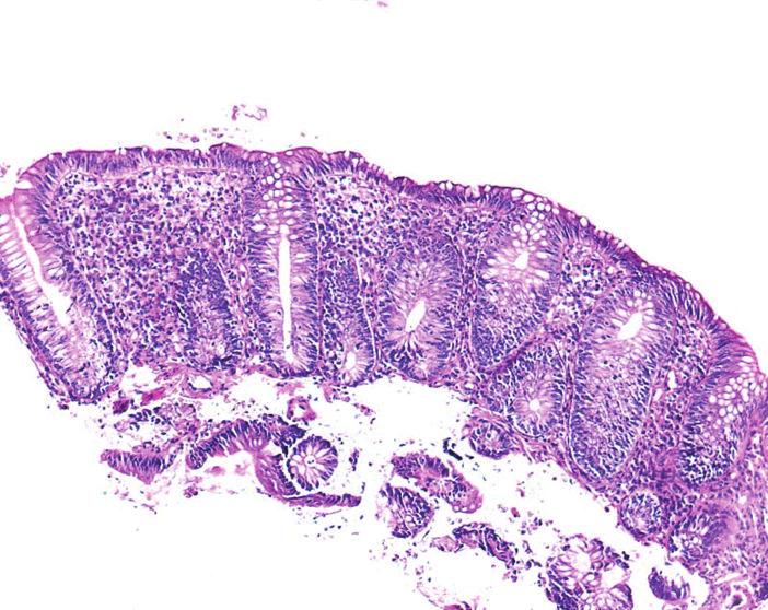 Biopsies from (g) descending colon (100x) and