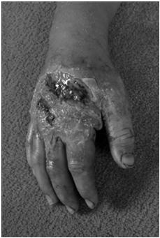 Slade,J, MD, et al, (eds), Hand Clinics: Scaphoid Fractures, Volume 17, No. 4, November 2001 Berger,R et al, (eds), Hand Clinics: External Fixation, Philadelphia, WB Saunders, Volume 9, No.