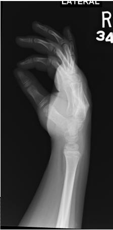 Journal of Hand Therapy 2003; 16(2): 81-92 Cannon N: Rehabilitation Approaches for Distal and Middle Phalanx Fractures of the Hand.
