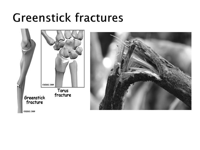 Greenstick fracture Physeal fractures Joint stability