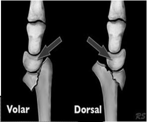 of radial carpal joint.