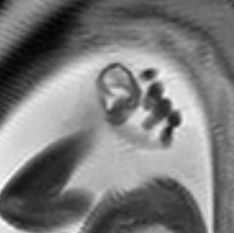 Fetal MRI assessment Sagittal image of the auricle on SSFP