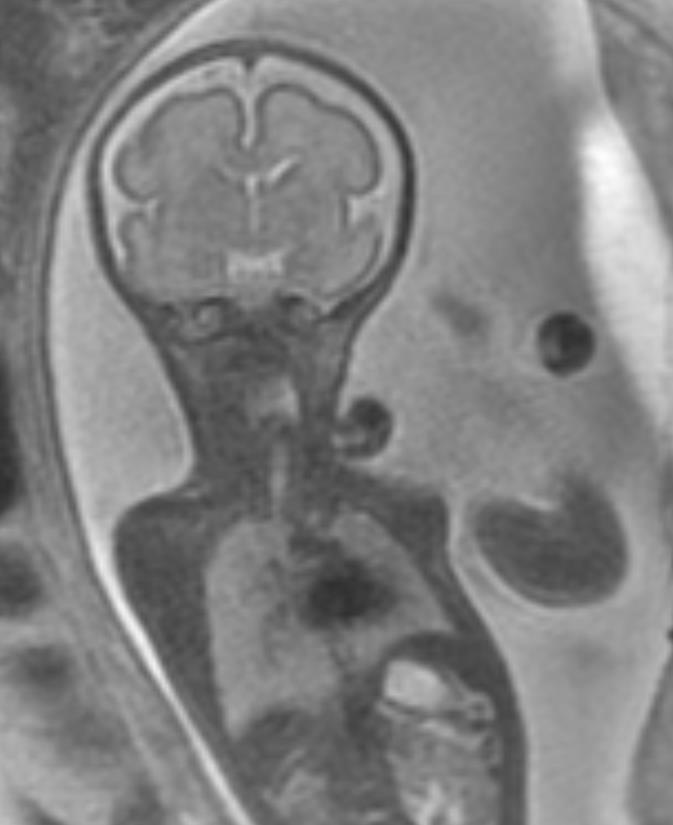 Fetal MRI assessment Absent