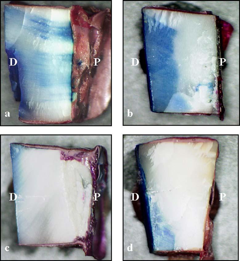 Stimulatory Effects of Laser on Exposed Dentinal Tubule 141 Fig. 2. Dye penetration test. D: dentin side, P: pulp side.