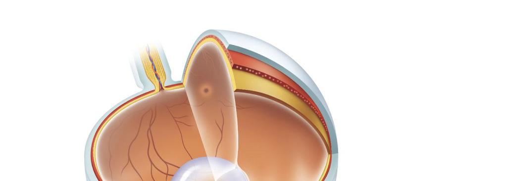 Vision Optic nerve Optic disk (blind spot) Light enters through the cornea Fovea Sclera Choroid Retina The lens focuses it to the back of the eye Vitreous humor (fills