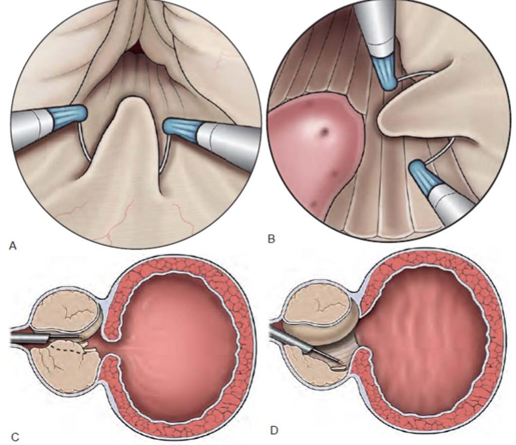Minimally Invasive and Endoscopic Management of Benign Prostatic Hyperplasia