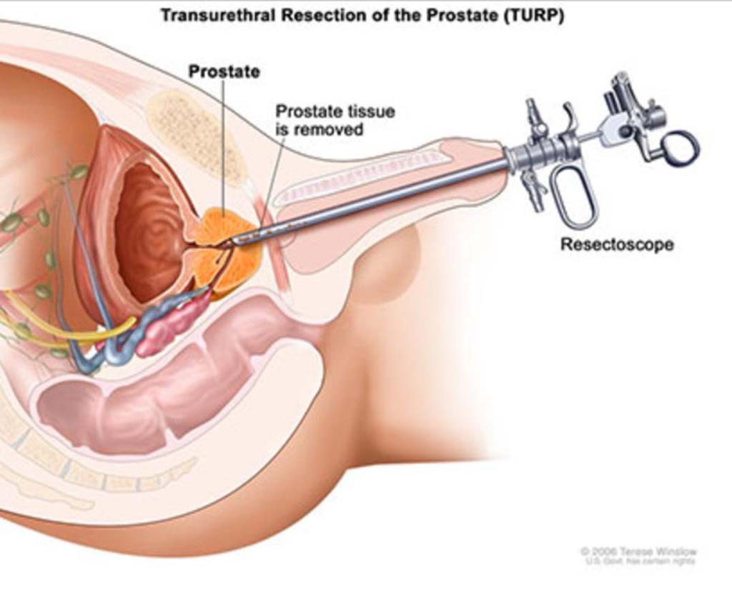 (Transurethral valporzation of prostate gland) TUMT (Transurethral microwave