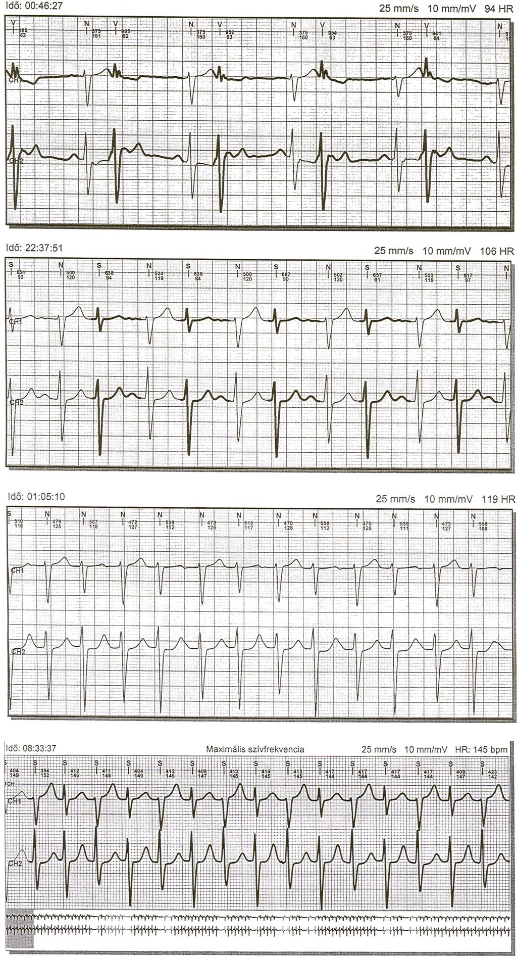 194 Vereckei A & Gellér L. Dual AV nodal nonreentrant tachycardia Figure 1.