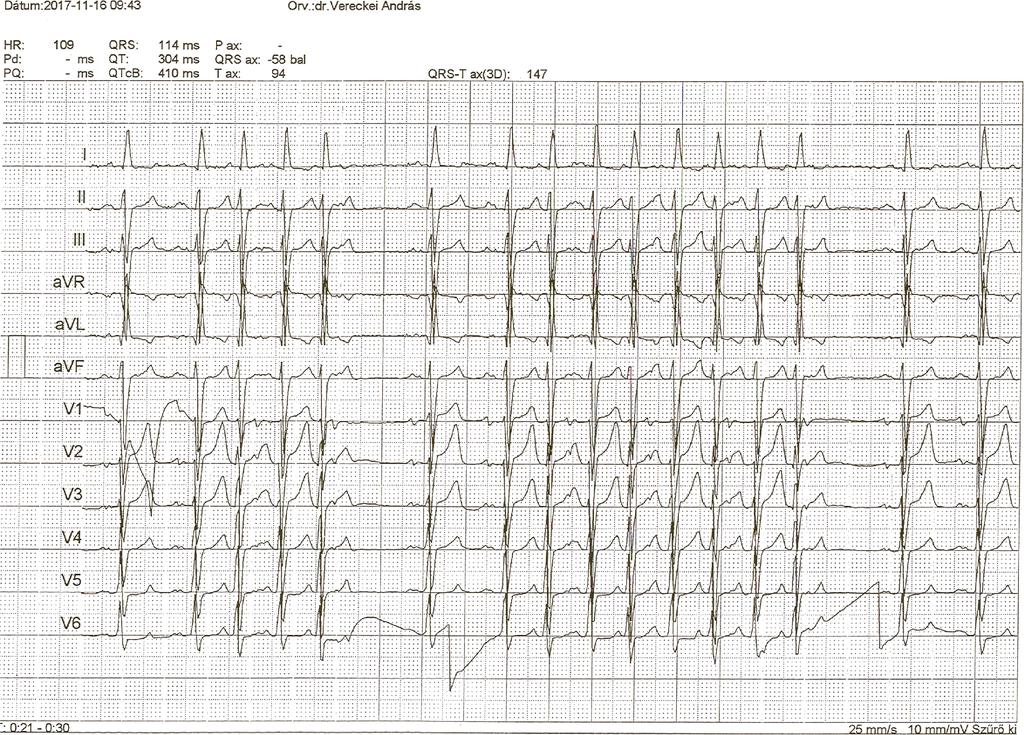Vereckei A & Gellér L. Dual AV nodal nonreentrant tachycardia 195 Figure 2. 12-lead ECG recorded right after 24-h ECG monitoring.