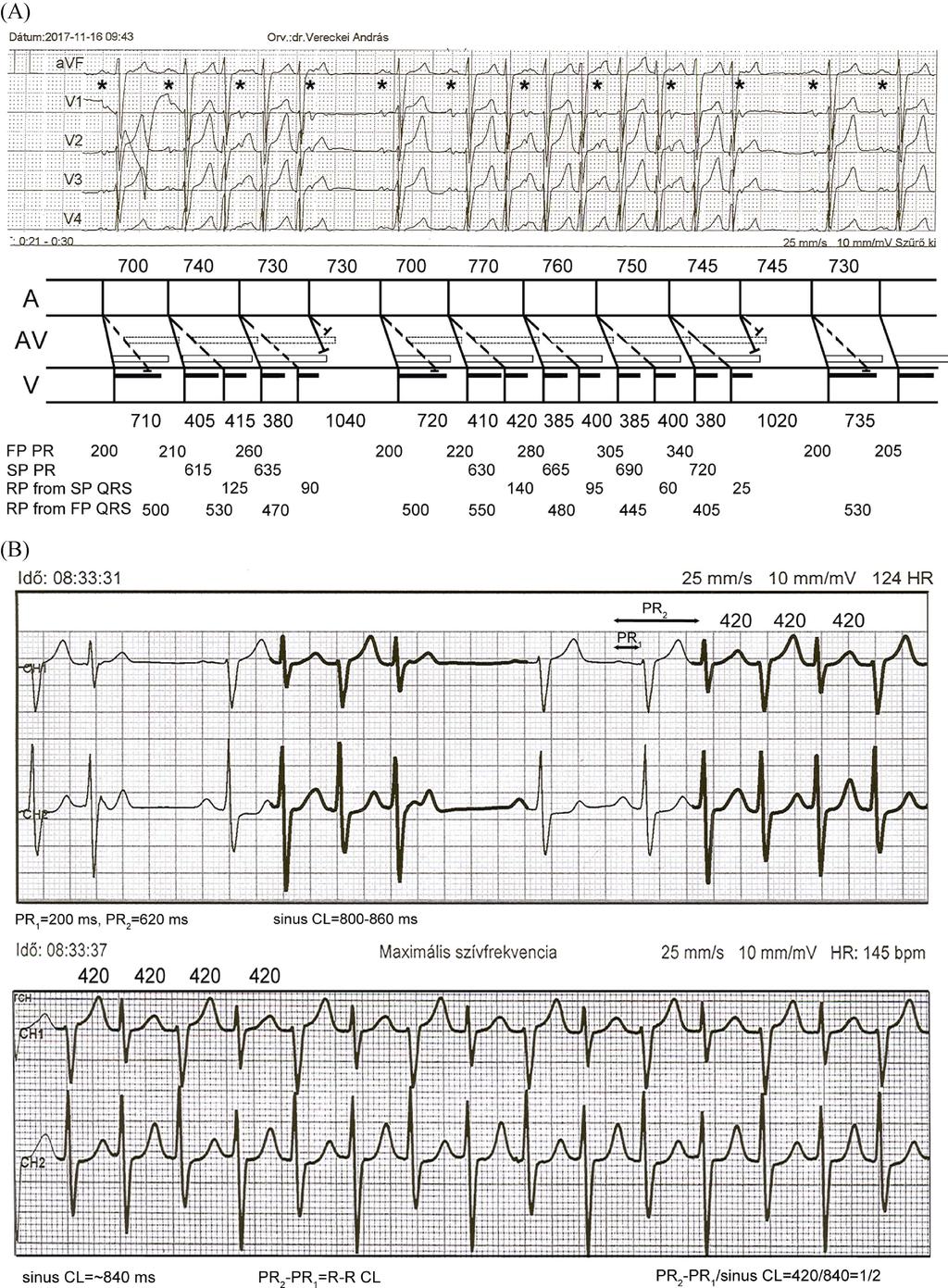 196 Vereckei A & Gellér L. Dual AV nodal nonreentrant tachycardia Figure 3. The elucidation of the possible mechanisms of arrhythmias shown in Figure 2 and Figure 1 4th rhythm strip.
