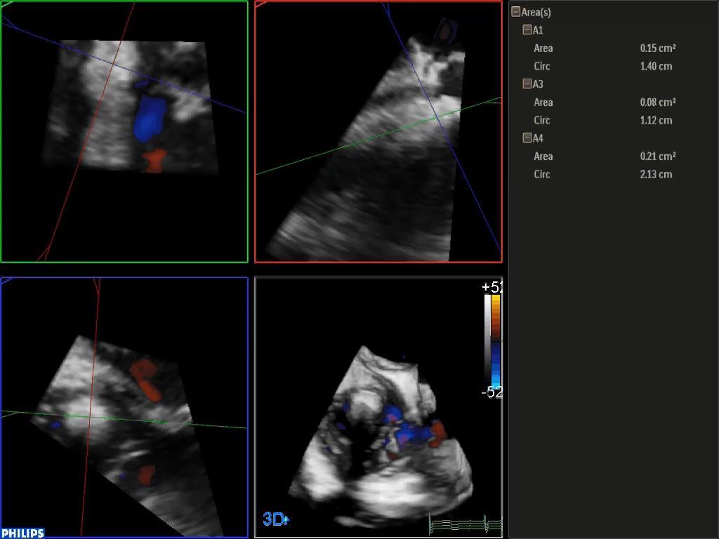 Tricuspid valve with FORMA in place: 3D Multiplanar