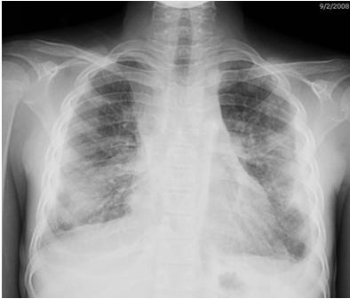 Conclusions pediatric TB (2) Gastric aspirates