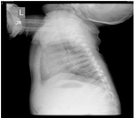 Which chest X-ray finding is more common in children than adults? 1. Enlarged lymph nodes (intrathoracic lymphadenopathy) 2. Pleural effusion 3. Apical disease 4.