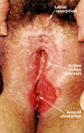 Management of Lichen Planus Lichen Sclerosus Association with beta-blockers, ACE inhibitors, lithium, HCTZ Topical steroid ointment (e.g. clobetasol, halobetasol) Nightly application for 2-3 months 71% complete response 1-3 times weekly for maintenance with mid or low potency steroid (2.