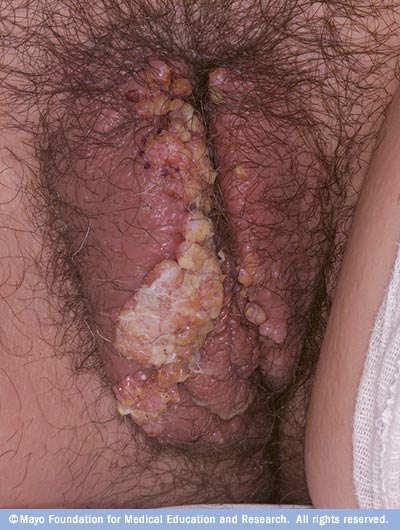 03% cream) Topical oxatomide may relieve pruritus through antihistamine effect Limited role of ablative and excisional procedures 1 Marren P et al, Br J Dermatol 1995 Vulvar Condyloma HPV 6/11