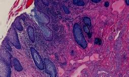 Mullerian origin (often associated with DES) Clear cell adenocarcinoma Endometrioid adenocarcinoma