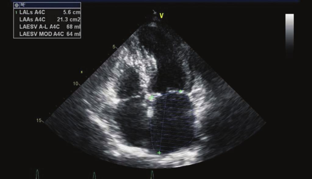 432 SECTION V Cardiac Imaging A B C D Figure 52-1.