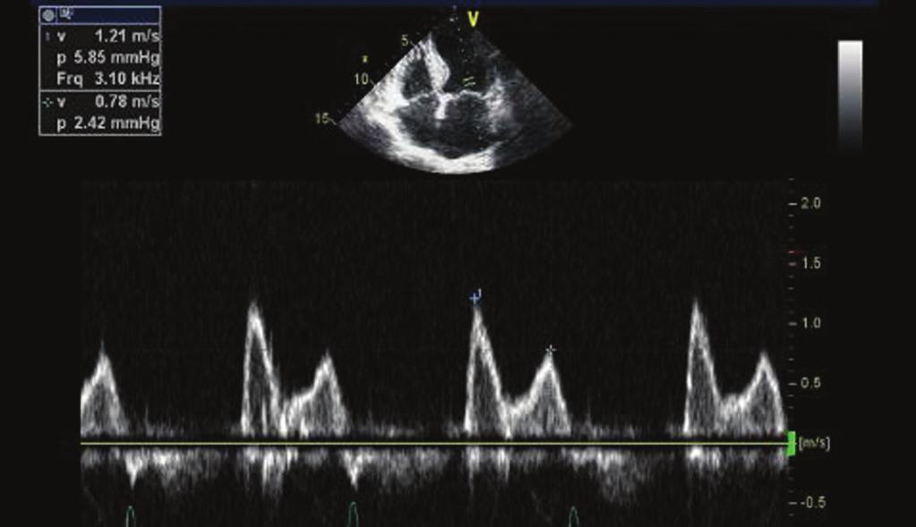 Chapter 52 Diastolic Stress Echocardiography 433 A B C Figure 52-2.