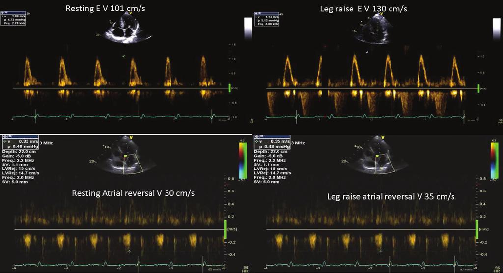 434 SECTION V Cardiac Imaging while at higher levels of LVFP it still can maintain acceptable sensitivity and specificity.
