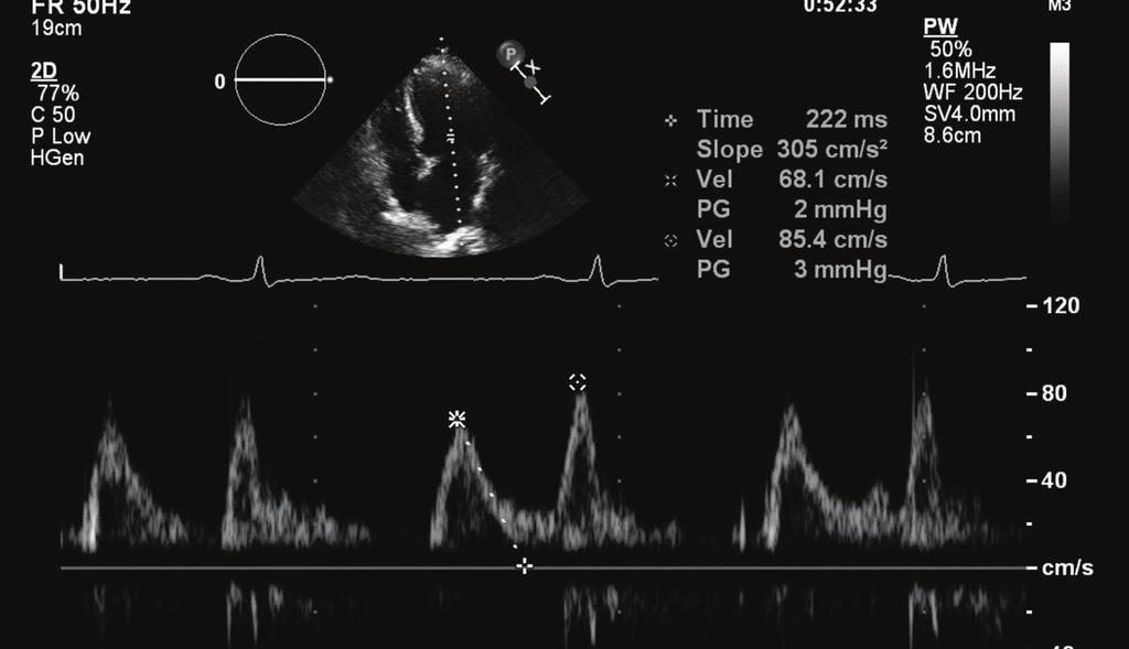 Chapter 52 Diastolic Stress Echocardiography 435 the legs can be passively lifted and rested on a chair with the torso slightly moved to the left side for better image acquisition.