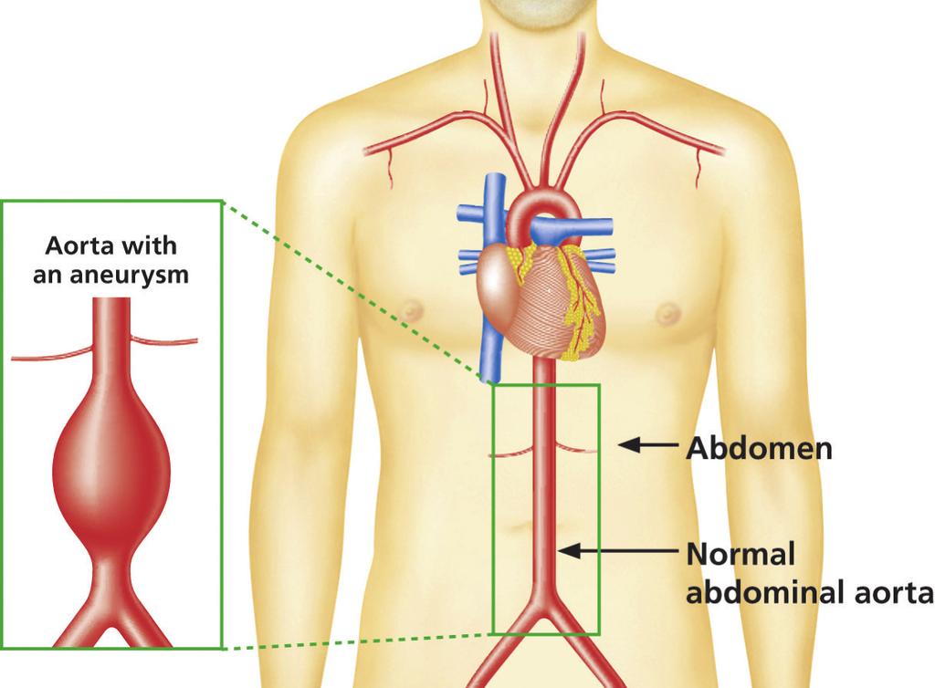 Your screening result We found that a section of your aorta is wider than normal. This means you have a medium abdominal aortic aneurysm (AAA). Around 1 in 550 men screened has a medium AAA.