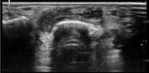 (c) MRI demonstrates an area in the synovial compartment which shows thickness greater than the width of the normal synovium and above normal post-gd enhancement suggestive of synovial thickening