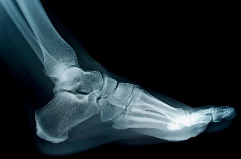 The ankle joint Tibia, fibula, talus Synovial hinge joint Flexion (dorsiflexion) and extension (plantaflexion) Fibula Talus Tibia Tarsal bones Small joints of the foot The tarsal bones together allow