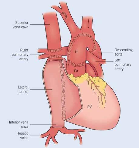 Total Cavopulmonary Connection Fontan 1971 Pulmonary blood flow is cardiac output