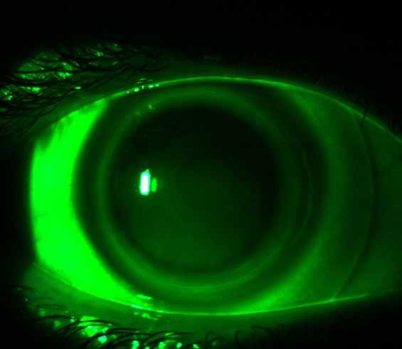 Ideal SynergEyes A Fit on a Normal Cornea Apical Clearance as Indicated by Slight Fluorescein Pooling Slight Fluorescein Presence