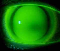 SynergEyes A Fit on a Keratoconic Cornea Step 3: Evaluate the Fit (continued) Irregular Corneas The ideal SynergEyes A fit on a prolate cornea will exhibit