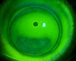 Ideal SynergEyes A Fit on a Keratoconic Cornea Apical Clearance as Indicated by Fluorescein Pooling without Touch Light Landing at the RGP Periphery with