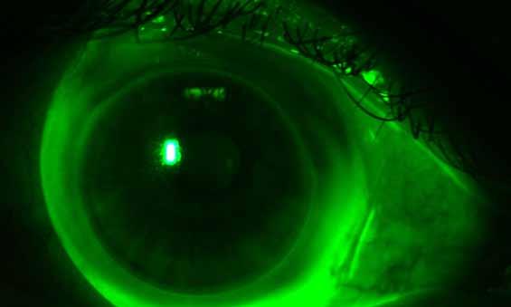 Troubleshooting & Tips for Success Base Curve Changes The base curve of the SynergEyes A lens may be steepened to: Provide a better fit for patients with higher amounts of corneal astigmatism Improve