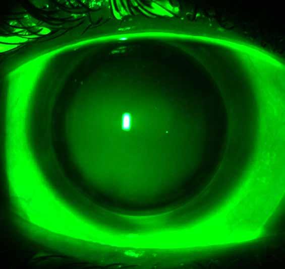 Troubleshooting & Tips for Success Fluorescein Pooling Under the Periphery of the Soft Skirt