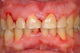 Gingivitis The mildest periodontal disease, reversible and may