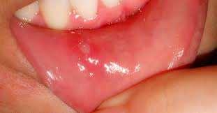 Aphthous ulceration Superficial painful oral lesion, occurring in recurrent bouts at intervals between few days to few months.