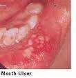 aphthous ulcer