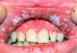 ulcer Oral