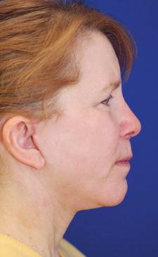 ... Augmentation rhinoplasty is a term used to describe nasal surgery in which the shape of the nose is increased.